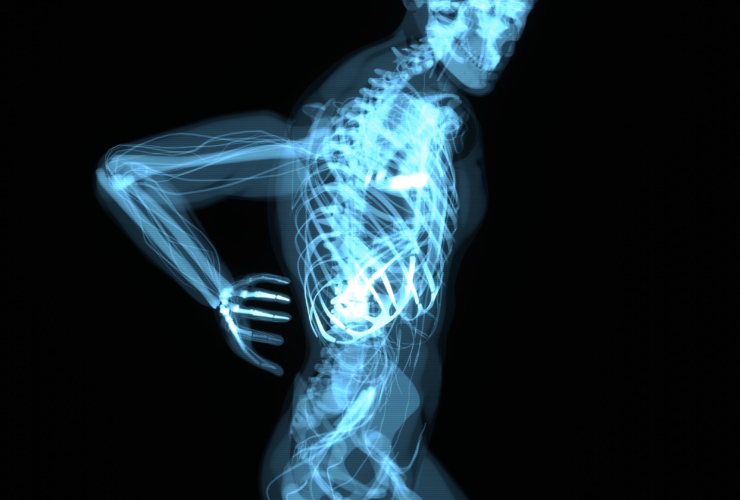 εκφυλιστική δισκοπάθεια